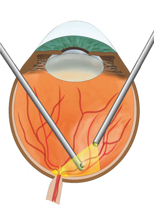 جراحی لیزیک و لازک
